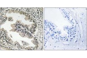 Immunohistochemistry analysis of paraffin-embedded human prostate carcinoma tissue, using SH3GLB2 Antibody. (SH3GLB2 antibody  (AA 131-180))