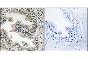 Immunohistochemistry analysis of paraffin-embedded human prostate carcinoma tissue, using SH3GLB2 Antibody. (SH3GLB2 antibody  (AA 131-180))