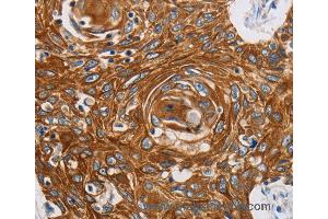Immunohistochemistry of Human liver cancer using GRIN1 Polyclonal Antibody at dilution of 1:45 (GRIN1/NMDAR1 antibody)