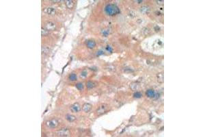 Formalin-fixed and paraffin-embedded human cancer tissue reacted with the primary antibody, which was peroxidase-conjugated to the secondary antibody, followed by DAB staining. (p21 antibody  (C-Term))
