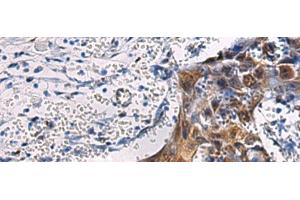 Immunohistochemistry of paraffin-embedded Human esophagus cancer tissue using SORD Polyclonal Antibody at dilution of 1:45(x200) (SORD antibody)