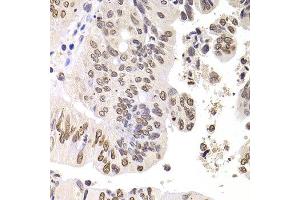 Immunohistochemistry of paraffin-embedded human colon carcinoma using SOX5 antibody at dilution of 1:100 (x400 lens). (SOX5 antibody)