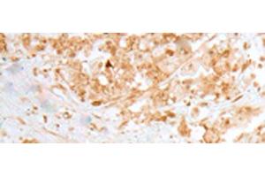 Immunohistochemistry of paraffin-embedded Human colorectal cancer tissue using MOB1B Polyclonal Antibody at dilution of 1:25(x200) (MOBKL1A antibody)