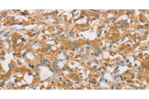 Immunohistochemistry of paraffin-embedded Human thyroid cancer using ARHGEF7 Polyclonal Antibody at dilution of 1:40 (ARHGEF7 antibody)