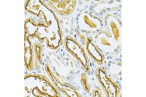 Immunohistochemistry of paraffin-embedded human kidney cancer using GLRX Antibody (ABIN5973060) at dilution of 1/200 (40x lens). (Glutaredoxin 1 antibody)