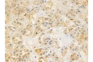ABIN6263880 and ABIN6272763 at 1/100 staining human renal cell carcinoma by IHC-P.