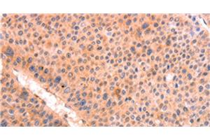 Immunohistochemistry of paraffin-embedded Human liver cancer tissue using LEP Polyclonal Antibody at dilution 1:30 (Leptin antibody)