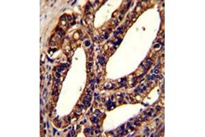 Formalin-fixed and paraffin-embedded human prostate carcinoma reacted with ORAI1 Antibody (Center) followed which was peroxidase-conjugated to the secondary antibody, followed by DAB staining. (ORAI1 antibody  (Middle Region))