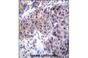 DVL3 Antibody immunohistochemistry analysis in formalin fixed and paraffin embedded human breast carcinoma followed by peroxidase conjugation of the secondary antibody and DAB staining. (DVL3 antibody  (C-Term))