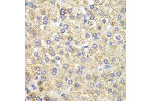 Immunohistochemistry of paraffin-embedded human liver cancer using HADH antibody (ABIN5970434) at dilution of 1/100 (40x lens).