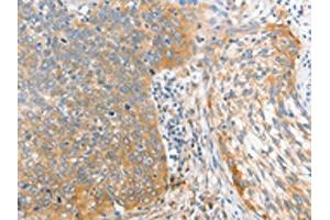The image on the left is immunohistochemistry of paraffin-embedded Human cervical cancer tissue using ABIN7128369(ALPI Antibody) at dilution 1/25, on the right is treated with fusion protein. (Intestinal Alkaline Phosphatase antibody)