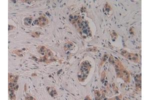 Detection of CASP4 in Human Breast cancer Tissue using Polyclonal Antibody to Caspase 4 (CASP4) (Caspase 4 antibody  (AA 290-377))