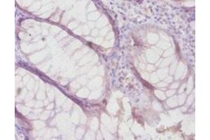 Immunohistochemistry of paraffin-embedded human colon cancer using ABIN7159497 at dilution of 1:100
