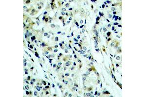 Immunohistochemistry of paraffin-embedded human breast carcinoma using Phospho-HDAC5-S498 antibody (ABIN2987596). (HDAC5 antibody  (pSer498))