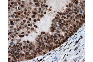 Immunohistochemical staining of paraffin-embedded Adenocarcinoma of breast tissue using anti-LTA4H mouse monoclonal antibody. (LTA4H antibody)