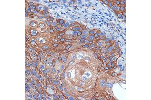 Immunohistochemistry of paraffin-embedded human esophageal cancer using BCL2L12 Rabbit mAb (ABIN7265864) at dilution of 1:100 (40x lens). (BCL2L12 antibody)