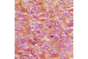 Immunohistochemical analysis of PARD3 staining in human breast cancer formalin fixed paraffin embedded tissue section. (PARD3 antibody  (C-Term))