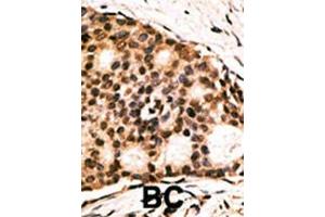 Formalin-fixed and paraffin-embedded human cancer tissue reacted with the primary antibody, which was peroxidase-conjugated to the secondary antibody, followed by AEC staining. (CDX1 antibody  (C-Term))