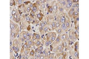 Immunohistochemistry of paraffin-embedded Human liver cancer using GAS2 Polyclonal Antibody at dilution of 1:200 (40x lens).