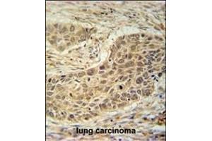TAF1D Antibody (N-term) (ABIN651786 and ABIN2840399) immunohistochemistry analysis in formalin fixed and paraffin embedded human lung carcinoma followed by peroxidase conjugation of the secondary antibody and DAB staining.