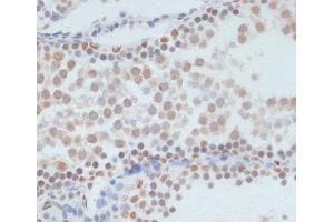 Immunohistochemistry (Paraffin-embedded Sections) (IHC (p)) image for anti-Tumor Protein P53 (TP53) (pSer33) antibody (ABIN7265276)