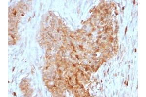 Formalin-fixed, paraffin-embedded human Breast Carcinoma stained with GPI Mouse Monoclonal Antibody (CPTC-GPI-1).