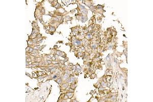 Immunohistochemistry of paraffin-embedded human lung cancer using Na+/K+-ATPase Rabbit pAb (ABIN6133568, ABIN6137299, ABIN6137301 and ABIN6223860) at dilution of 1:50 (40x lens). (ATP1A1 antibody  (AA 1-100))