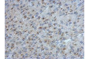 IHC-P Image Immunohistochemical analysis of paraffin-embedded U87 xenograft, using UGCGL2, antibody at 1:500 dilution. (UGCGL2 antibody)
