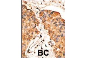 Formalin-fixed and paraffin-embedded human cancer tissue reacted with the primary antibody, which was peroxidase-conjugated to the secondary antibody, followed by DAB staining. (Neuregulin 1 antibody  (AA 198-229))