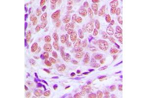 Immunohistochemical analysis of KLF11 staining in human breast cancer formalin fixed paraffin embedded tissue section. (KLF11 antibody  (N-Term))