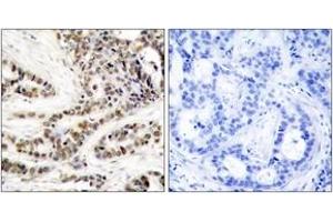 Immunohistochemistry analysis of paraffin-embedded human breast carcinoma, using CREB (Phospho-Ser129) Antibody. (CREB1 antibody  (pSer129))