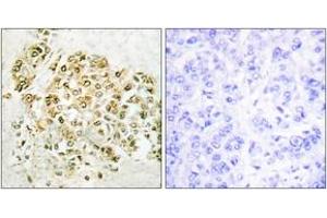Immunohistochemistry analysis of paraffin-embedded human breast carcinoma tissue, using MZF-1 Antibody. (MZF1 antibody  (AA 1-50))