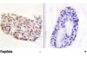 Immunohistochemical analysis of paraffin-embedded human breast carcinoma tissue using NFAT5 polyclonal antibody . (NFAT5 antibody  (AA 1190-1240))