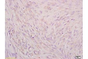 Formalin-fixed and paraffin embedded human cervical carcinoma tissue labeled with Anti CIP2A/p90 Autoantigen Polyclonal Antibody,Unconjugated (ABIN760241) at 1:200 followed by conjugation to the secondary antibody and DAB staining.