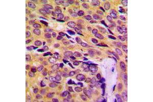 Immunohistochemical analysis of MRPL14 staining in human breast cancer formalin fixed paraffin embedded tissue section. (MRPL14 antibody  (C-Term))