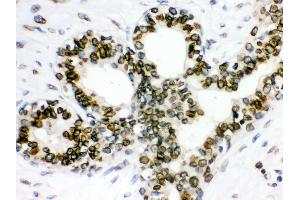Anti- Lamin B1 Picoband antibody, IHC(P) IHC(P): Human Mammary Cancer Tissue (Lamin B1 antibody  (AA 266-583))