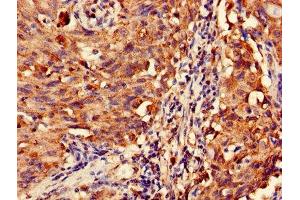 Immunohistochemistry of paraffin-embedded human lung cancer using ABIN7159021 at dilution of 1:100 (MAS1L antibody  (AA 318-378))