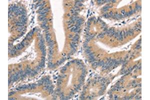 The image on the left is immunohistochemistry of paraffin-embedded Human colon cancer tissue using ABIN7190351(CRIM1 Antibody) at dilution 1/25, on the right is treated with synthetic peptide. (CRIM1 antibody)
