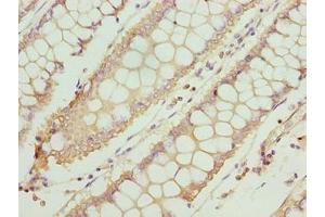 Immunohistochemistry of paraffin-embedded human colon cancer using ABIN7171923 at dilution of 1:100 (TTC30A antibody  (AA 201-500))
