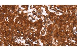 Immunohistochemistry of paraffin-embedded Human gasrtic cancer tissue using HCAR2 Polyclonal Antibody at dilution 1:40 (HCAR2 antibody)