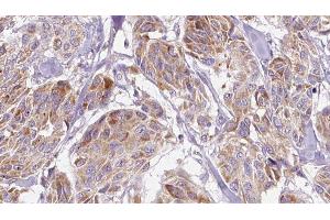 ABIN6276682 at 1/100 staining Human Melanoma tissue by IHC-P. (CXCL10 antibody  (C-Term))