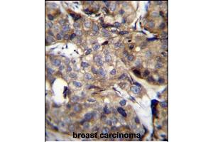 TM4SF1 Antibody (N-term) (ABIN656640 and ABIN2845885) immunohistochemistry analysis in formalin fixed and paraffin embedded human breast carcinoma followed by peroxidase conjugation of the secondary antibody and DAB staining. (TM4SF1 antibody  (N-Term))