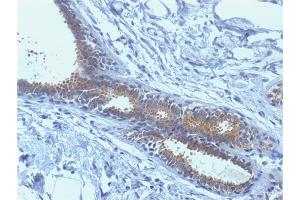 Formalin-fixed, paraffin-embedded human Breast Carcinoma stained with BRCA1 Mouse Monoclonal Antibody (BRCA1/1398). (BRCA1 antibody  (AA 445-620))