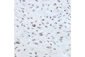 Immunohistochemistry of paraffin-embedded human esophageal cancer using SRRM1 Rabbit pAb (ABIN6133184, ABIN6148463, ABIN6148464 and ABIN6221692) at dilution of 1:450 (40x lens). (SRRM1 antibody  (AA 1-160))