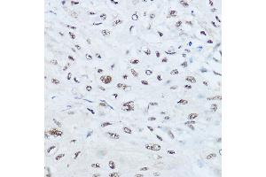 Immunohistochemistry of paraffin-embedded human esophageal cancer using SRRM1 Rabbit pAb (ABIN6133184, ABIN6148463, ABIN6148464 and ABIN6221692) at dilution of 1:450 (40x lens).