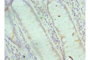 Immunohistochemistry of paraffin-embedded human colon cancer using ABIN7153696 at dilution of 1:100 (FABP6 antibody  (AA 1-128))