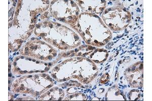 Immunohistochemical staining of paraffin-embedded Adenocarcinoma of Human ovary tissue using anti-IGF2BP2 mouse monoclonal antibody. (IGF2BP2 antibody)