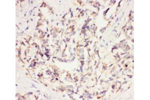 IHC-P: VEGF antibody testing of human lung cancer tissue (VEGFA antibody  (AA 27-191))