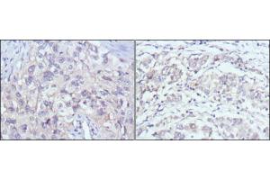 Immunohistochemical analysis of paraffin-embedded human lung cancer (left) and gastric cancer (right) using PAK2 mouse mAb with DAB staining.