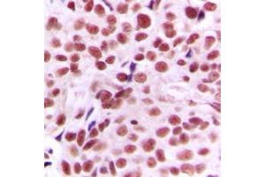 Immunohistochemical analysis of c-Myc staining in human breast cancer formalin fixed paraffin embedded tissue section.